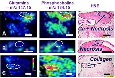 Multiplatform Metabolomics Studies of Human Cancers With NMR and Mass Spectrometry Imaging